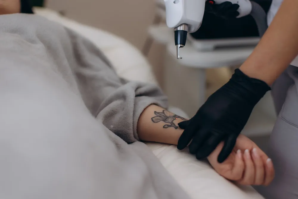 Remoção de Tatuagem a Laser em Natal