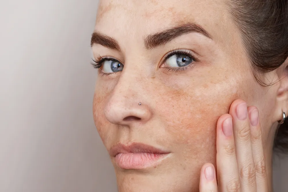 Por que o melasma aparece?