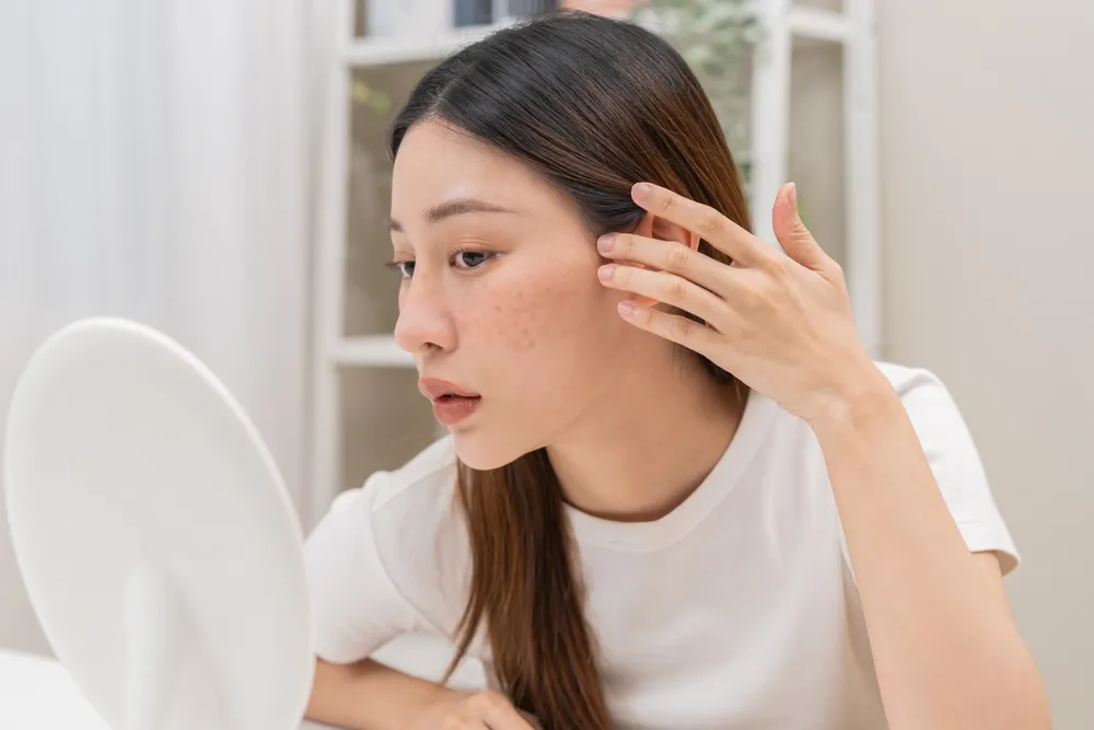 Tratamento para Melasma em Natal